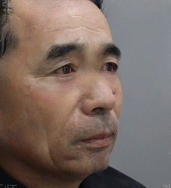 去眼袋手术