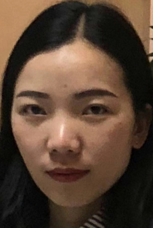去眼袋手术
