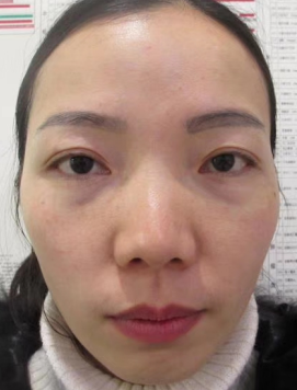 去眼袋手术