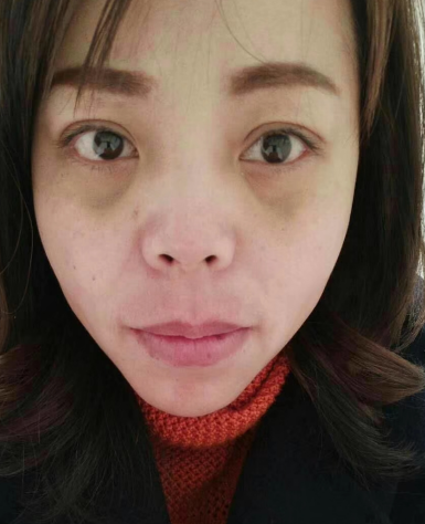 去眼袋手术