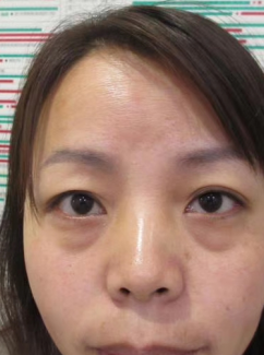 去眼袋手术