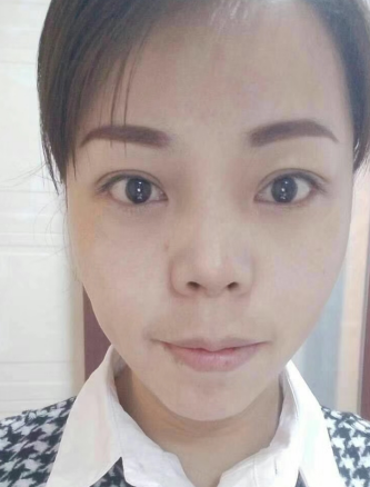 去眼袋手术