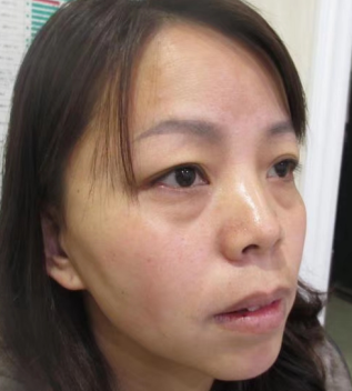 去眼袋手术