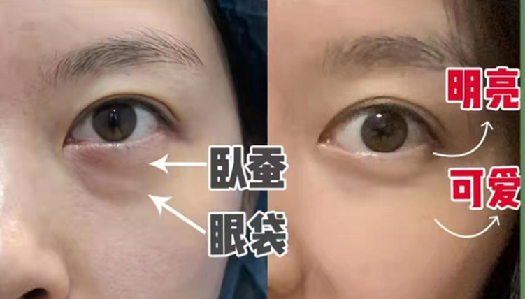 眼袋
