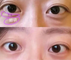 眼袋