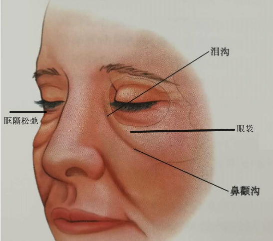 眼袋