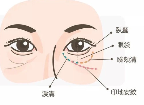 眼袋