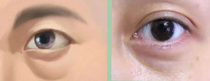 眼袋