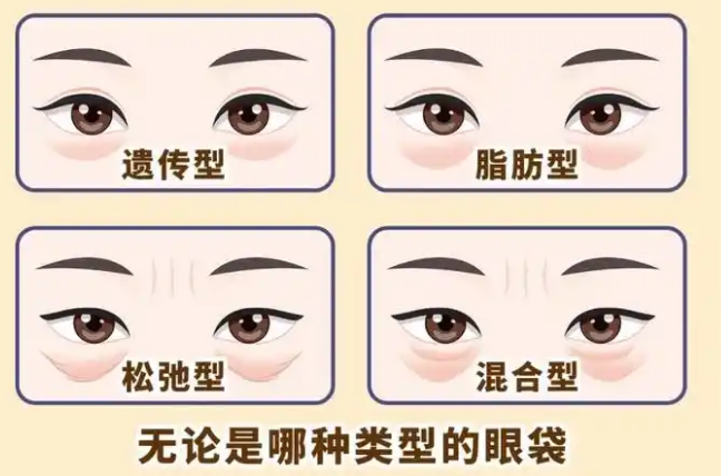 去眼袋手术
