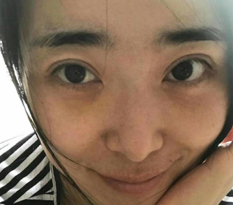 去眼袋手术