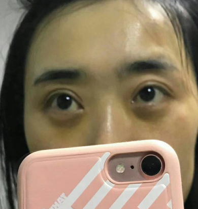 去眼袋手术