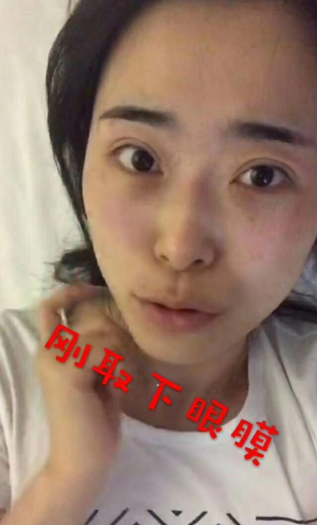 去眼袋手术