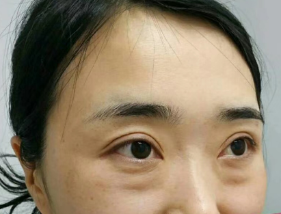 去眼袋手术