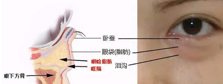 去眼袋手术