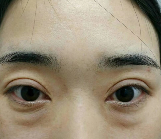 去眼袋手术