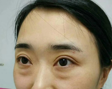 去眼袋手术