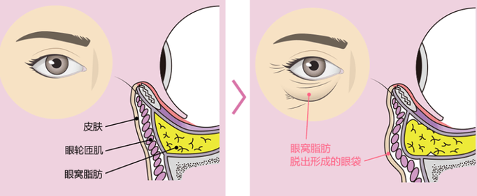 去眼袋手术