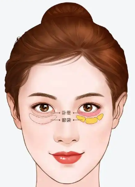去眼袋手术