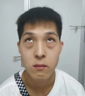 去眼袋手术