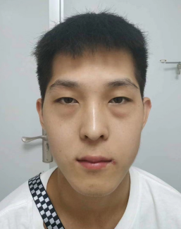 去眼袋手术