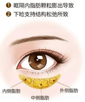 去眼袋手术