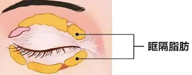 去眼袋手术