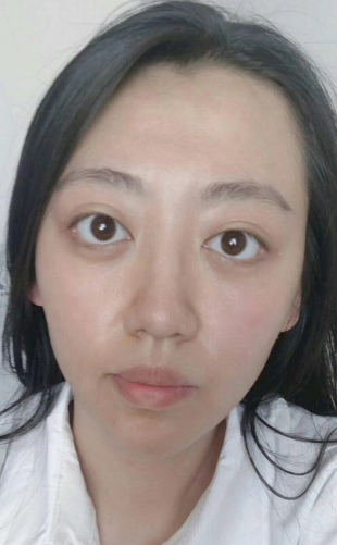 去眼袋手术