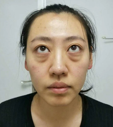 去眼袋手术