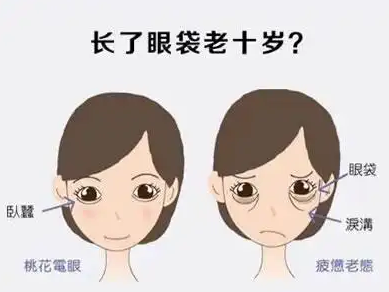 去眼袋手术