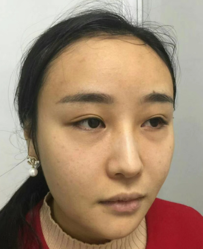 去眼袋手术