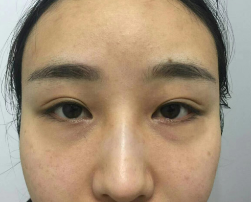 去眼袋手术