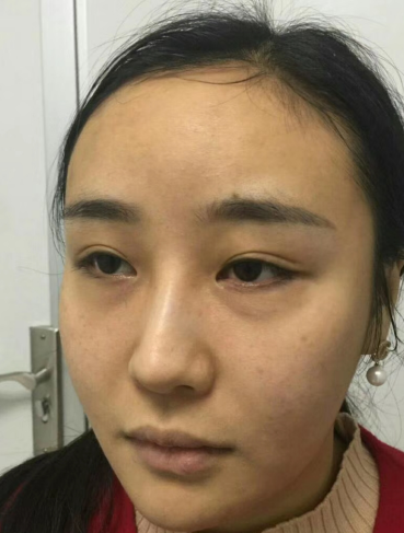 去眼袋手术