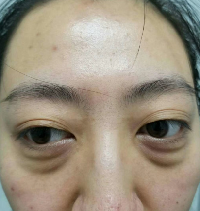 去眼袋手术