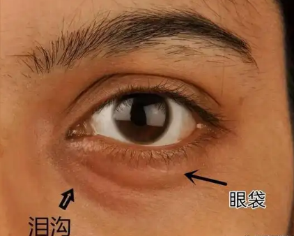 去眼袋手术