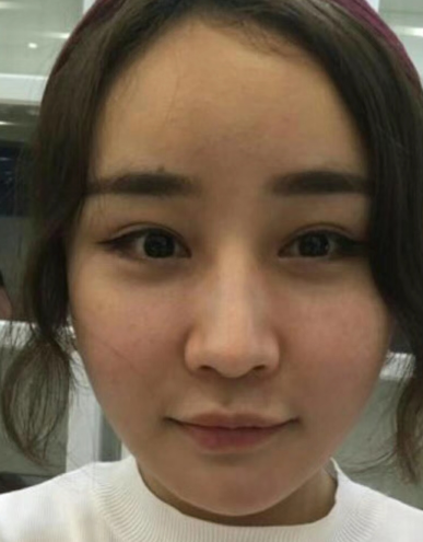 去眼袋手术