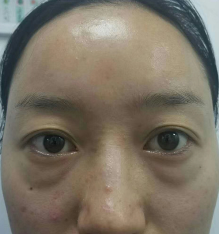 眼袋