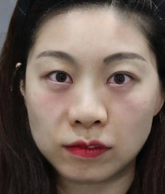 去眼袋手术