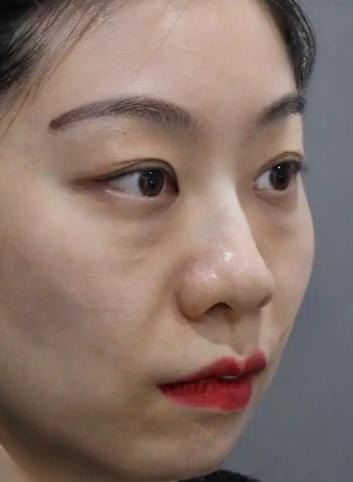 去眼袋手术