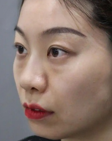 去眼袋手术