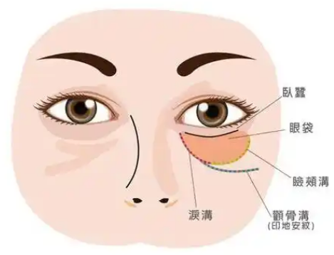 去眼袋手术