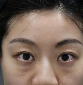 去眼袋手术
