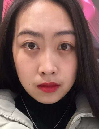 去眼袋手术