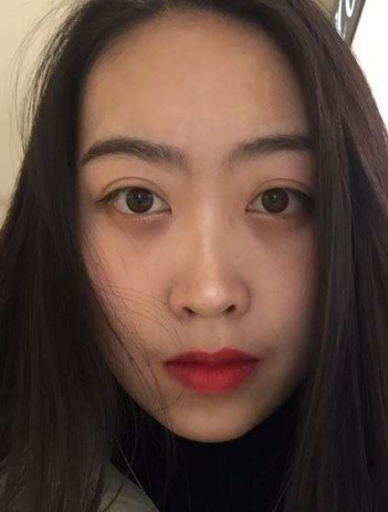 去眼袋手术