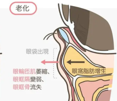 去眼袋手术