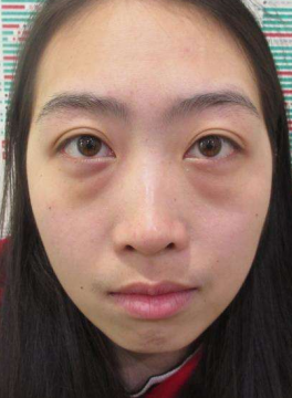 去眼袋手术