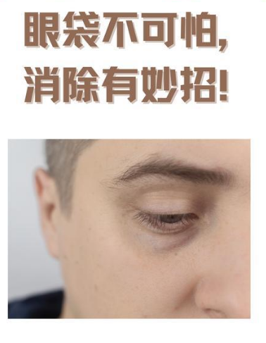 去眼袋手术