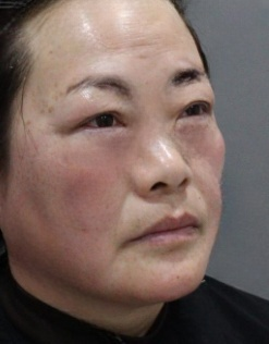 去眼袋手术