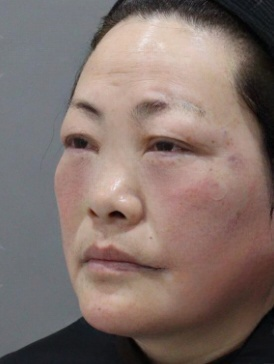 去眼袋手术