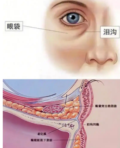 去眼袋手术