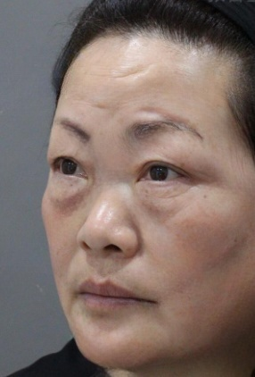 去眼袋手术